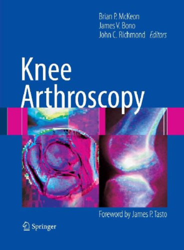 McKeon, Brian P. - Bono, James V. - Richmond, John C.: Knee Arthroscopy idegen